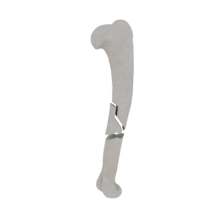 Kość Ramienna - Kot- Złamanie typu 12-B1 wg AOVet